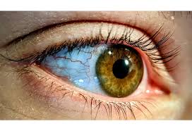 Image result for Strabismus