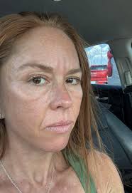 Can the high sodium make your eyes puffy?