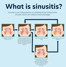Image result for Rhinitis