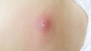 Image result for Skin Abscess