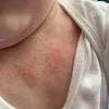 When bathing babies with eczema, remember these tips: 1