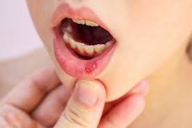 Sariawan atau dalam bahasa medis stomatitis adalah infeksi yang terjadi pada mulut bisa disebabkan oleh jamur, virus, hingga infeksi akibat bakteri. 4 Obat Sariawan Alami Agar Terbebas Dari Rasa Perih Dan Nyeri Alodokter