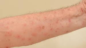 Image result for scabies on humans