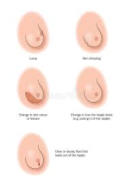 Please check your breast regularly and don't ignore anything that is different. Signs Of Breast Cancer Stock Illustration Illustration Of Biology 25364751