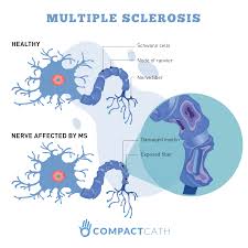 Multiple sclerosis is an autoimmune disease in which the immune system attacks and destroys the protective covering of nerve cells (myelin) of the brain, spinal cord, and/or eyes. Bladder Management With Multiple Sclerosis Compactcath