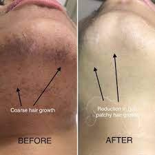 So, how does laser hair removal work? Dos And Donts After A Laser Hair Removal Session 2021