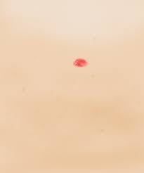 One of the forms of tiny red dots on skin is petechiae. What Causes Red Spots On Skin Guide To Treatment Types