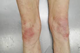 Es tritt als ergebnis der. Die Leichenschau Fakten Und Fallstricke Doctors Today