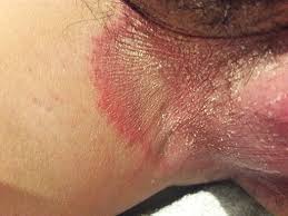 Image result for sore skin in the groin area