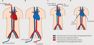 Used as a supportive strategy in patients who. Extracorporeal Membrane Oxygenation Indications Technique And Contemporary Outcomes Heart