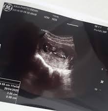 Bagasaruk cinta lo bertepuk sebelah tangan? Pregnancy Journey Trimester Pertama Kehamilan Emilinda