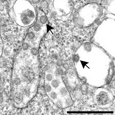 Maybe you would like to learn more about one of these? Caution In Identifying Coronaviruses By Electron Microscopy American Society Of Nephrology