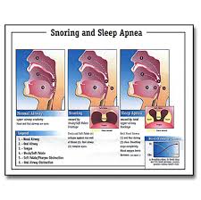 Snoring Sleep Apnea Chart