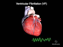 Image result for Ventricular Fibrillation