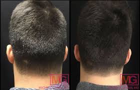 The technique involves using multiple tiny, sterile needles to puncture the skin and cause. Hair Loss Nyc Dermatologist Specialist Guide To Hair Loss Treatment Options