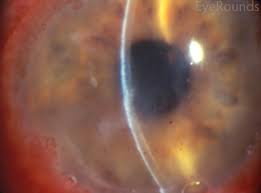 Most corneal injuries and infections are associated with severe pain, although sometimes. Herpes Simplex Keratitis