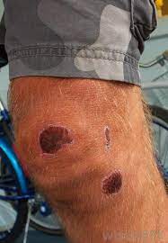 Once the scab forms, it takes around two weeks to heal completely, if you use an antiseptic. What Are The Stages Of Wound Healing With Pictures