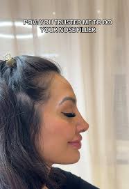 My clients final results after her two week top up, no edits, nothing fake  just raw footage of one extremely happy client after getting her nose  filler with me in Fulham, London 🤍 #nosefiller ...