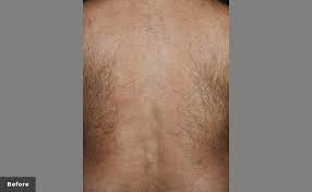 I would recommend laser hair removal 100%. Hair Removal Cutera