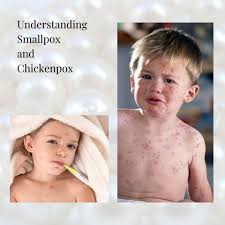 Image result for Smallpox