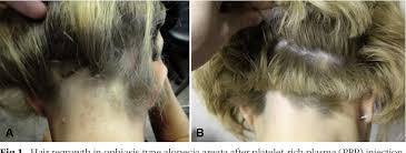 Percentage of subjects achieving an absolute severity of alopecia tool (salt) score <=10 (for ema/vhp countries)  time frame: Successful Treatment Of Corticosteroid Resistant Ophiasis Type Alopecia Areata Aa With Platelet Rich Plasma Prp Semantic Scholar
