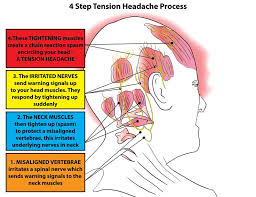 Started about a year ago, but they are getting stronger and last longer. 6 Pressure Points For Soothing Headache Tension Easily