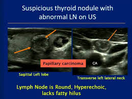 The image may or may not suggest cancer, but definitive diagnosis requires removal of. Thyroid Ultrasound Course Youtube