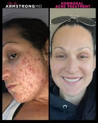 One of the most life changing treatments I offer is for hormonal acne.  Hormonal acne can be more than just a skin issue—it can impact your  confidence, your self-esteem, and how you
