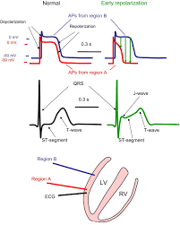 Image result for Early Repolarization