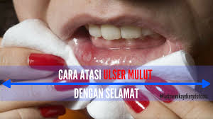 Cara menghilangkan mual selanjutnya adalah dengan cengkeh. Cara Atasi Ulser Mulut Secara Selamat Ladywankaydiary Com
