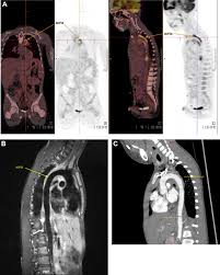 The prior version is no longer supported but remains available here. Uncommon Cause Of Chest Pain In A 9 Year Old Boy With Crohn S Disease Gastroenterology