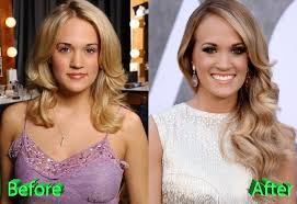 Carrie Underwood Before And After Plastic Surgery Carrie Underwood Plastic Surgery Celebrity Plastic Surgery Carrie Underwood