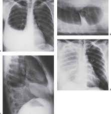 Lateral decubitus films may show loculated pleural effusions or small pleural effusions not visible. Diseases Of The Pleura Diaphragm And Chest Wall Radiology Key