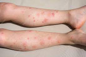 Allergic Reaction To Mosquito Bites Stock Image C047 4708 Science Photo Library