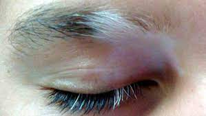 Brown spots on face treatment in hindi mein bahut badiya bataya gya hai. Premature Grey Hairs In Eyebrows Reverse With 7 Permanent Solutions