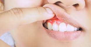 Gingivitis is a common and mild form of gum disease (periodontal disease) that causes irritation, redness and swelling (inflammation) of your gingiva, the part of your gum around the base of your teeth. What Are The Different Stages Of Gum Disease