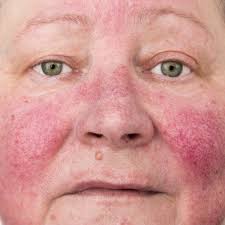 Global Look at Data Indicates Which Subtypes of Rosacea Are Most Prevalent