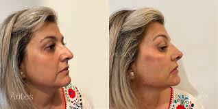 Laura's Case : Before and after Cheek Augmentation : FB