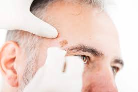Skin cancer is the most common type of cancer in the united states by a pretty large margin, and it does not discriminate. Skin Cancer Removal Skin Cancer Reconstruction Grand Rapids Mi