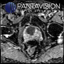 Prostate cancer is one of the most common types of cancer diagnosed in men. Prostate Mri Prostate Cancer Transition Zone Low Signal Intensity Hypointense Adc Pantavision Digital Diagnostics