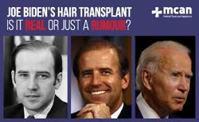 #njplasticsurgery #drwise #plasticsurgeon #opinion #plasticsurgery #joebiden #interesting. Joe Biden S Hair Transplant Is It Real Or Just A Rumour Hair Transplant Plastic Surgery In Istanbul Turkey Mcan Health