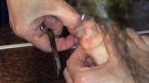 eingewachsenen fuss nagel entfernen eingewachsenen zehennagel behandeln mit nagelschere anleitung youtube