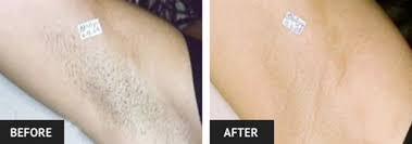 Dealing with unwanted hair is not a pain anymore! The Benefits Of Laser Hair Removal St Louis Cosmetic Surgery Reviews