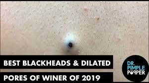 16 grossest pimple popping videos that are disgustingly satisfying. Best Of Blackheads And Dilated Pores Of Winer For 2019 Youtube