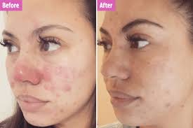 Vitamin e topical vitamin e has long been a skincare hero— it can fade dark spots, calm inflammation, and moisturize —but ingesting the vitamin (as a supplement—please don't drink your serum!) is. Acne Sufferers Rave Over Life Changing Vitamins Which Cleared Their Skin In Just One Month