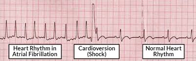Image result for Synchronized Cardioversion