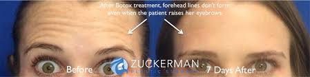 Includes dose adjustments, warnings and precautions. Botox Cosmetic Injections Treatment Nyc Top Ranked Zuckerman Plastic Surgery