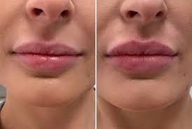 Before And After Lip Augmentation Performed Yesterday At Ovmenashville Filler Friday S Get Ready For The Weekend This Client Received One Syringe O