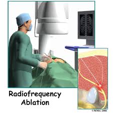 Image result for Radiofrequency Surgery