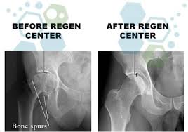 Hip resurfacing surgery is an alternative to standard hip replacements for patients with severe arthritis. Stem Cell Therapy For Hips Thighs Avn Osteonecrosis
